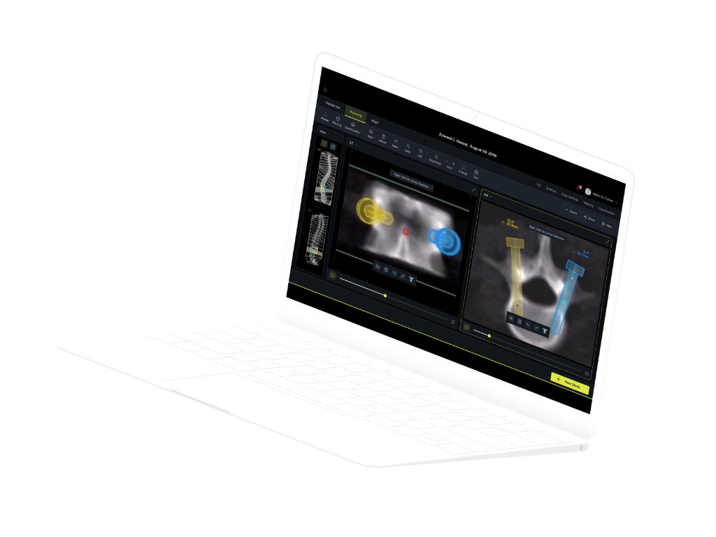 Mazorobotics planning screen on a laptop: spine scans with screw paths marked in yellow and blue